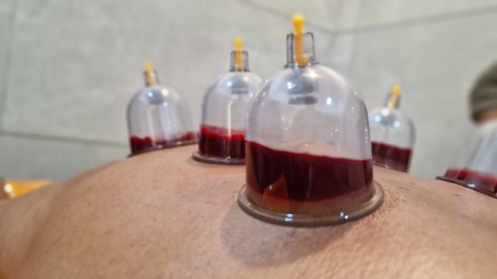 Dr Ali's Shafi Ayurveda Kalari Marma Chikitsaalayam